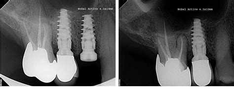 Nobel Biocare NobelActive Implant dentaire | SpotImplant