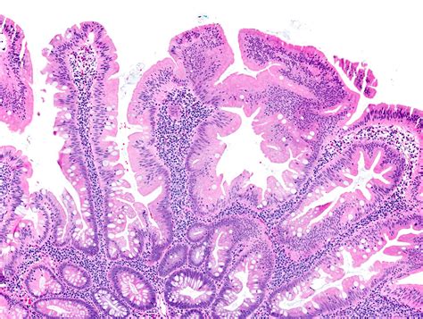 Sessile Polyp Histology