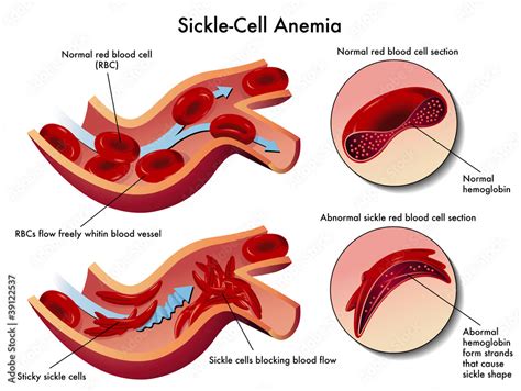 anemia falciforme Stock Vector | Adobe Stock