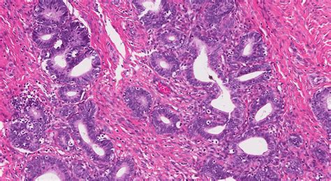 Histopathology Of Cervical Adenocarcinoma A The Prima - vrogue.co