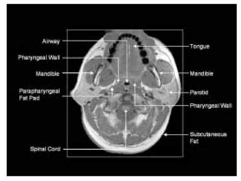 Mandible Anatomy Radiology - ANATOMY STRUCTURE