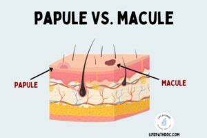 Papule vs Macule: Pictures, Differences, and Causes