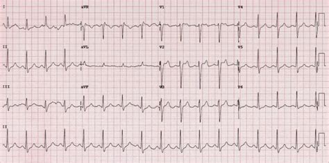 Brugada Syndrome • LITFL • ECG Library Diagnosis