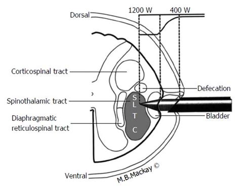 Cordotomy procedures for cancer pain: A discussion of surgical ...