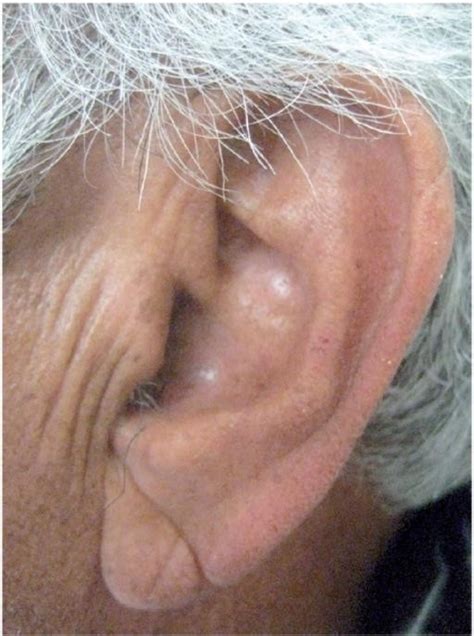 Lobule of Ear / Earlobe/ Auricular Lobule – Earth's Lab