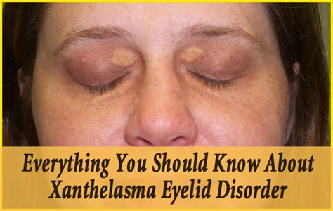 Everything You Should Know About Xanthelasma Eyelid Disorder ...