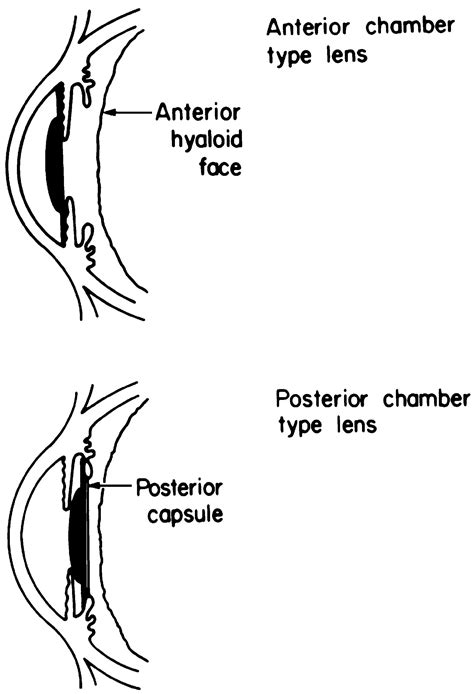 The two major types of intraocular lenses. - American Academy of ...