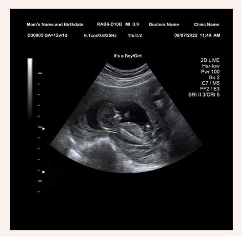 11 Week Ultrasound - Ultrasounds