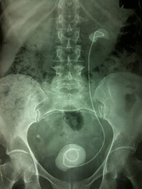 Ramayya Pramila Urology Hospital: Forgotten ureteric stent:Avoidable condition