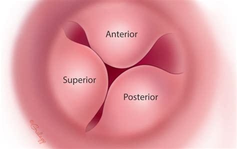 Exostoses of the Ear Canal – Oto Surgery Atlas