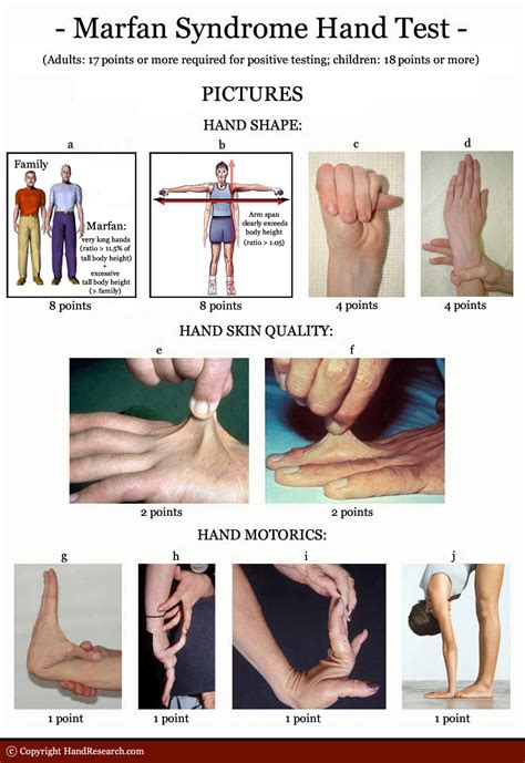 MARFAN SYNDROME - The language of the hands!