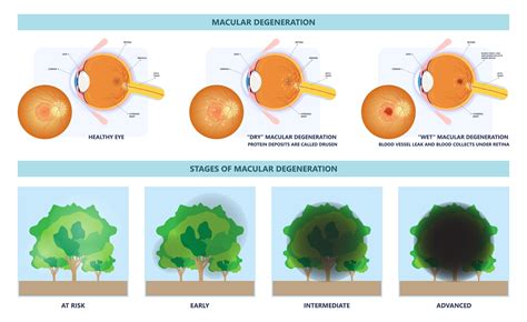 Macular Degeneration - Alaska Retinal Consultants