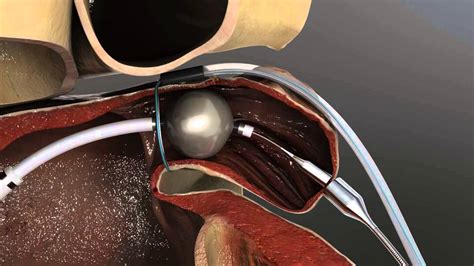 Left Atrial Appendage Occlusion | Westchester Medical Center - YouTube