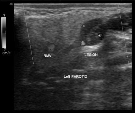 Parotid Gland Tumor Ultrasound