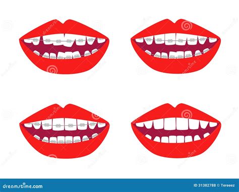 Braces vector set stock vector. Illustration of clipart - 31382788