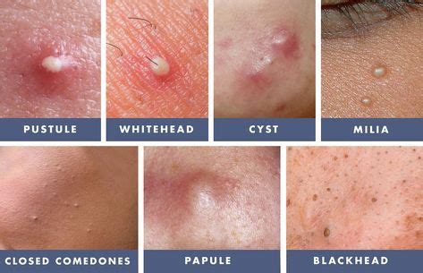 How To Get Rid of Whiteheads for Clear and Bump-Free Skin | Skin care acne, Skin facts, Types of ...