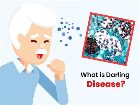 What Is Darling Disease? Know Symptoms, Causes, Risk Factors And ...