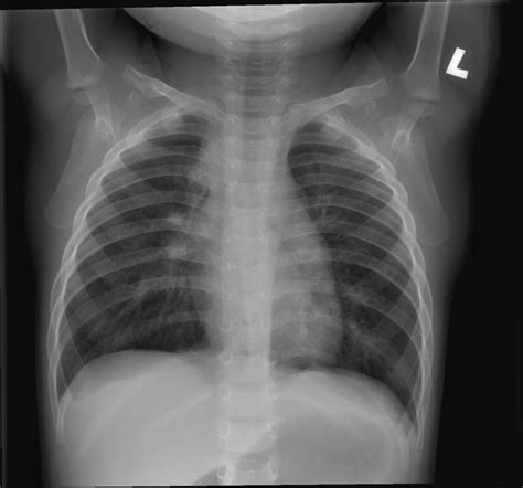 Bronchitis Lungs Xray