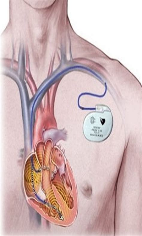 Amazon.com: About of Pacemaker Surgery: Appstore for Android