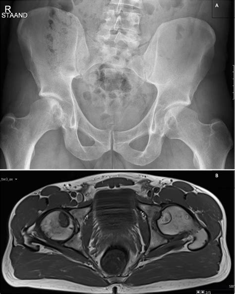 Atypical presentation of subchondral cysts in the femoral head | BMJ Case Reports