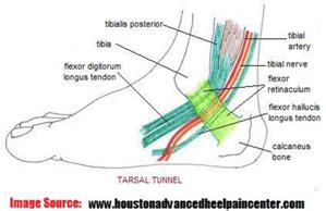 Tarsal Tunnel Syndrome - Fix Podiatry