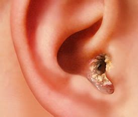 Otitis externa u Oído de nadador. Síntomas, causas y tratamiento.