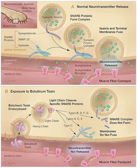 Botulinum Toxins: Bad Bug or Miracle Medicine? - Inquiries Journal