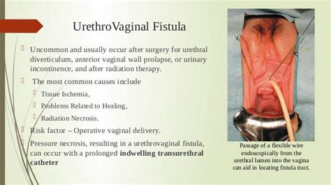 Urinary Tract Fistulas -(VVF) Etiology, Diagnosis, Management