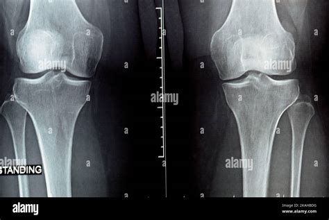 oído Experto Intacto que es esclerosis de las superficies articulares Fragua Mareo Obligar