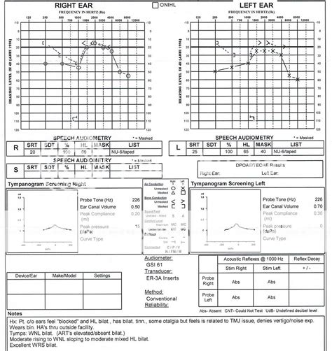 Two different results on audiograms, should I get a third? - Hearing ...