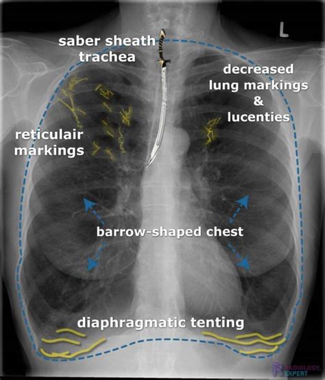 Copd Chest X Ray Frequency