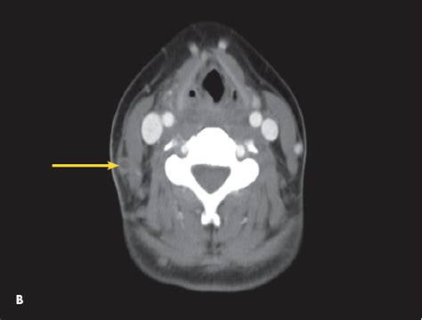 External Jugular Vein Thrombosis in an Adolescent With Lemierre ...