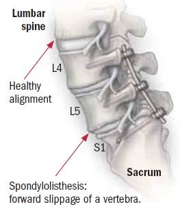 When is back surgery the right choice? - Harvard Health