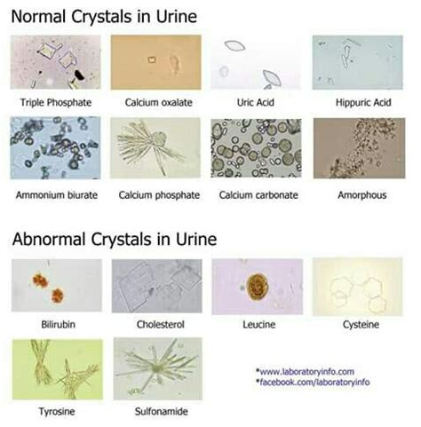 Normal cristal in urine | Bioquímica, Microbiología, Urinarios