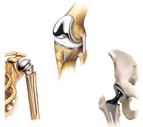 Total Joint Arthroplasty | Team Bone