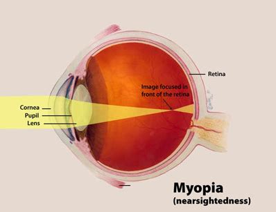 Eye Exercises for Myopia - Cure Nearsightedness with Eye Exercises