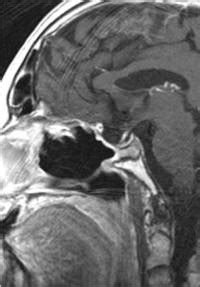 Pituitary Adenoma | Johns Hopkins Medicine