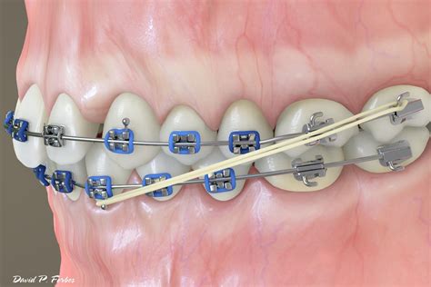 Treatment Auxillaries: Elastics (rubber bands) - Forbes Orthodontics