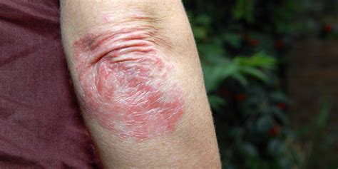 What Is Plaque Psoriasis? Symptoms, Treatments, and More | SELF