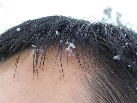 Snow in Alpha's hair - Merrits Nature Track, Thredbo | Flickr