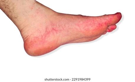 Secondary Syphilis Rash On Man Feet Stock Photo 2291984399 | Shutterstock