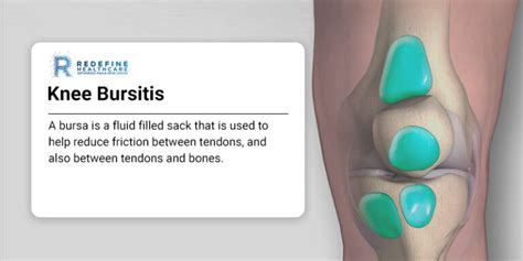 Knee Bursitis - NJ's Top Orthopedic Spine & Pain Management Center