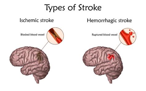 Understanding Stroke | Brain Institute | OHSU