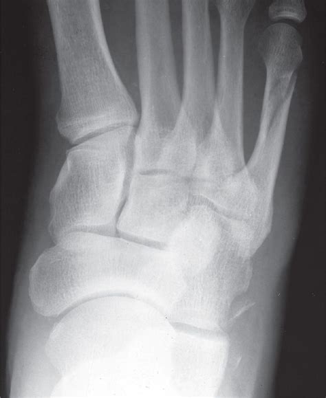 Cuboid Avulsion Fracture