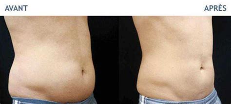 Before & After : Result of Cryolipolyse with Coolsculpting treatment