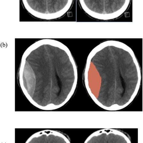 Representative CT images of basal cistern appearance. Patient with a... | Download Scientific ...