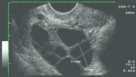 Ovarian Follicle Ultrasound