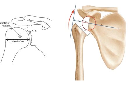 Reverse Shoulder Arthroplasty — OrthopaedicPrinciples.com