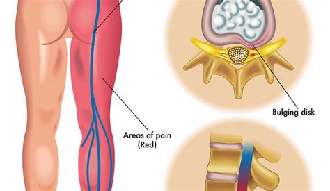 sciatic nerve pain in buttocks Archives - SAMARPAN PHYSIOTHERAPY CLINIC AHMEDABAD