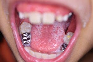 Learn Why Your Child May Need a Silver Crown - Salvaggio Dentistry Blog